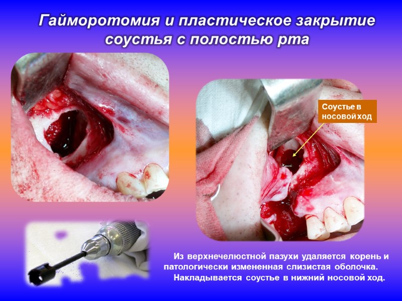 Гайморотомия и пластическое закрытие соустья с полостью рта     Из верхнечелюстной